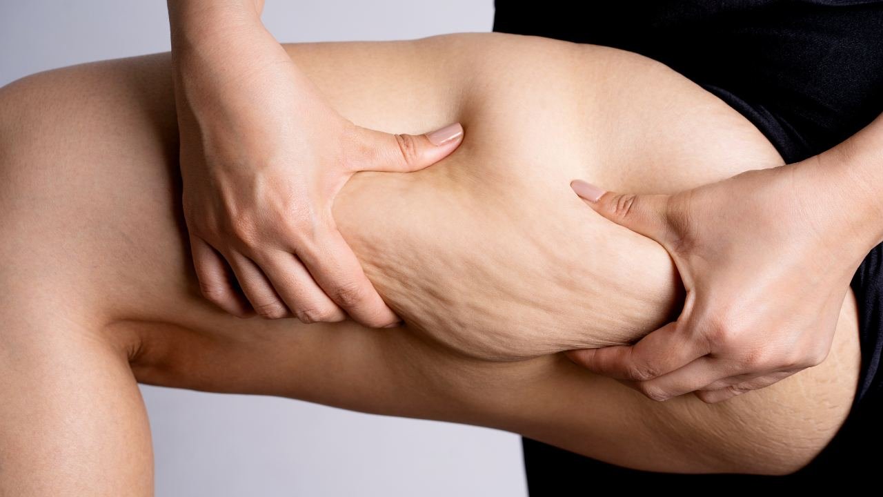 liposuzione gambe