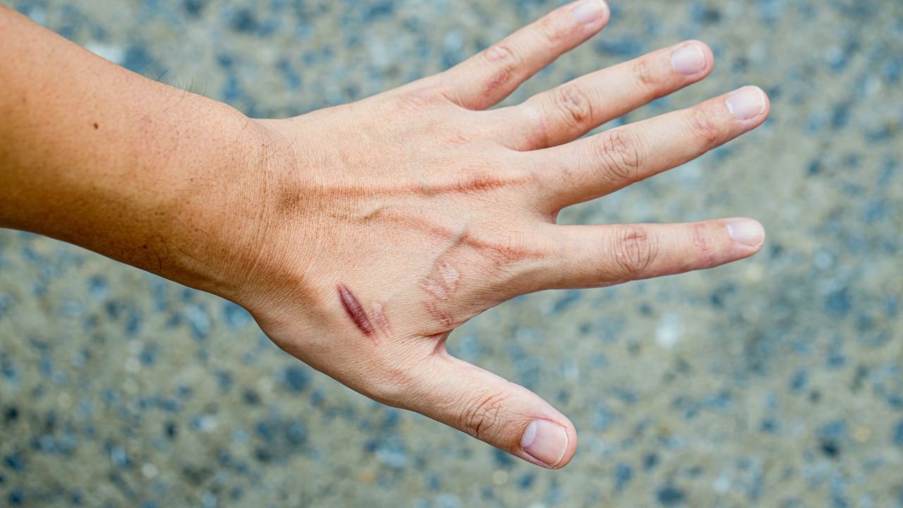 cicatrice cheloide