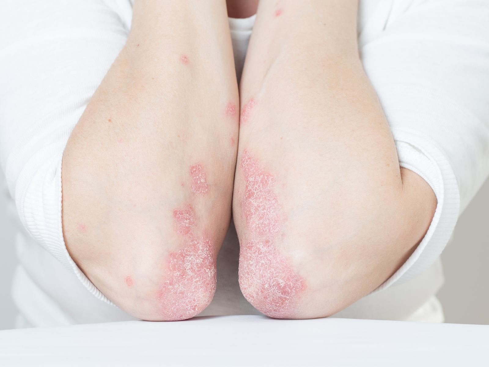 psoriasi dermatite