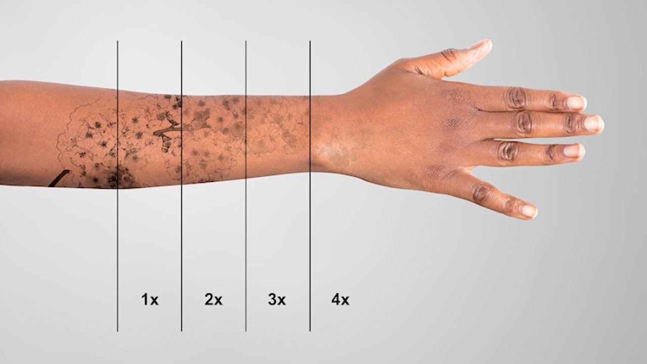 Laser per rimuovere tatuaggi