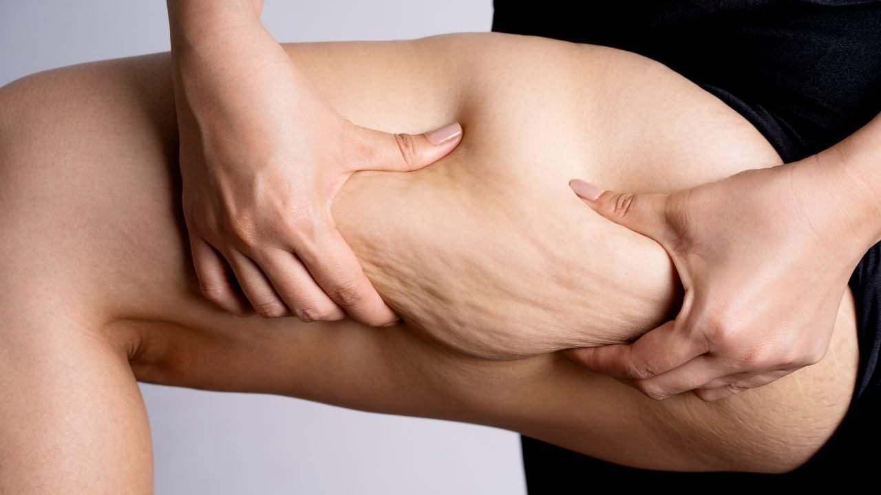 liposuzione gambe