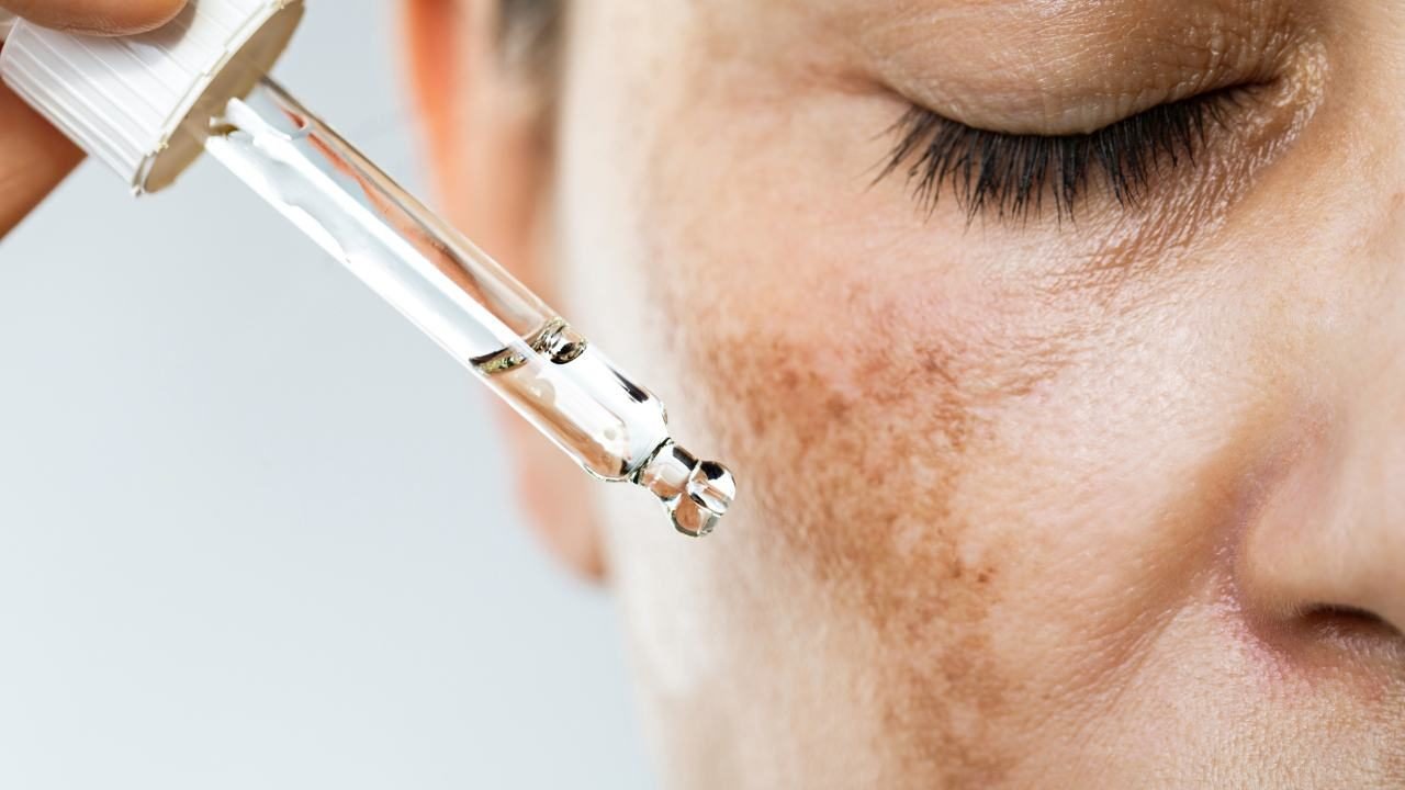 melasma fronte