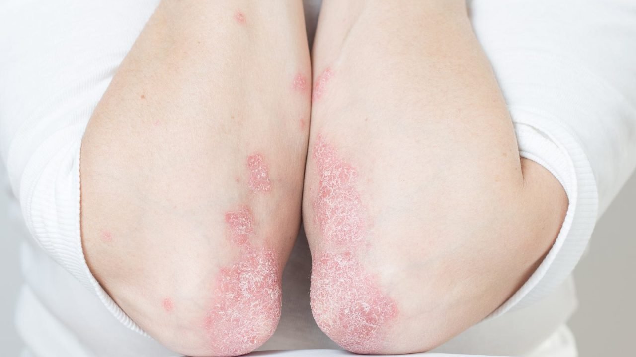 psoriasi dermatite