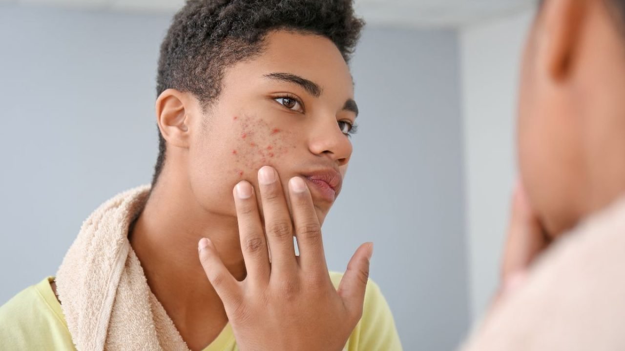 trattamenti anti acne